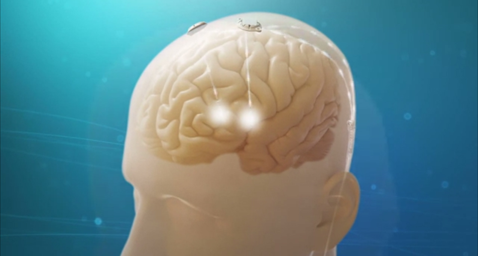 Sistema de estimulação cerebral profunda Vercise™